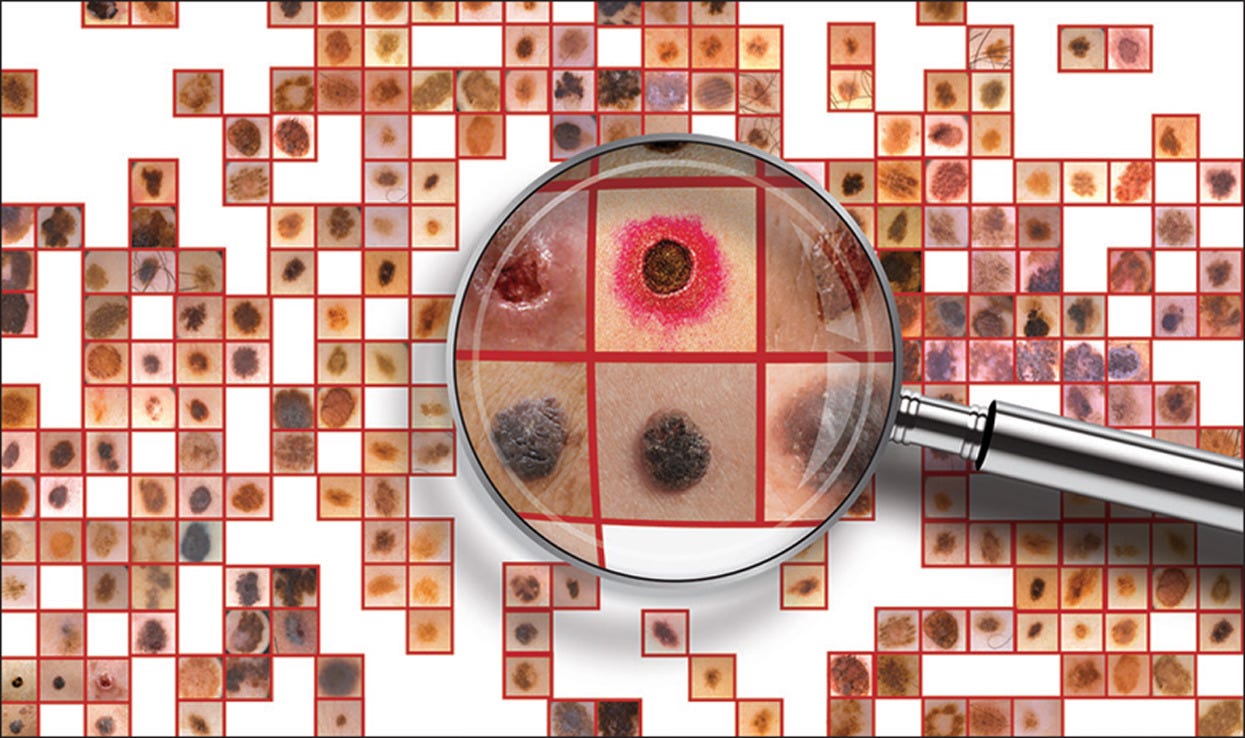 Skin Cancer Detection